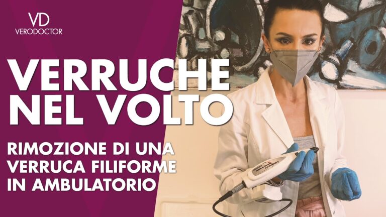Verruca filiforme: 3 soluzioni per eliminarla in modo efficace!