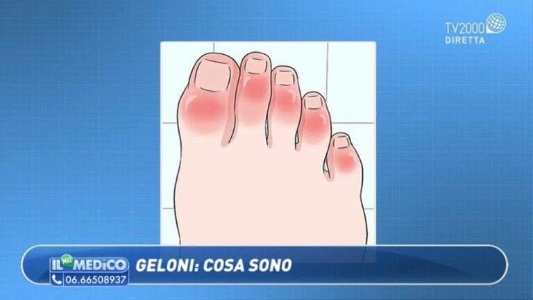 Scopri il mistero dei geloni: le possibili cause spiegate in breve