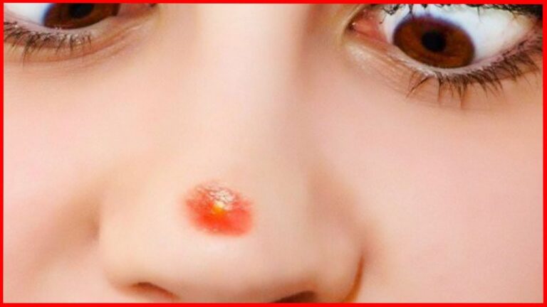 Addio brufolo: scopri come eliminare l’acne in modo efficace