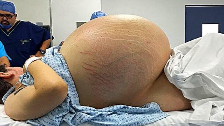 La soluzione definitiva per la pancia gonfia post parto: scopri i segreti dopo 2 anni!
